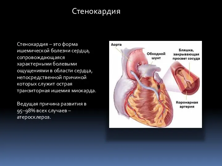 Стенокардия – это форма ишемической болезни сердца, сопровождающаяся характерными болевыми ощущениями в