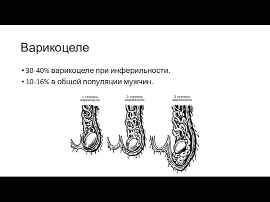 Варикоцеле 30-40% варикоцеле при инферильности. 10-16% в общей популяции мужчин.