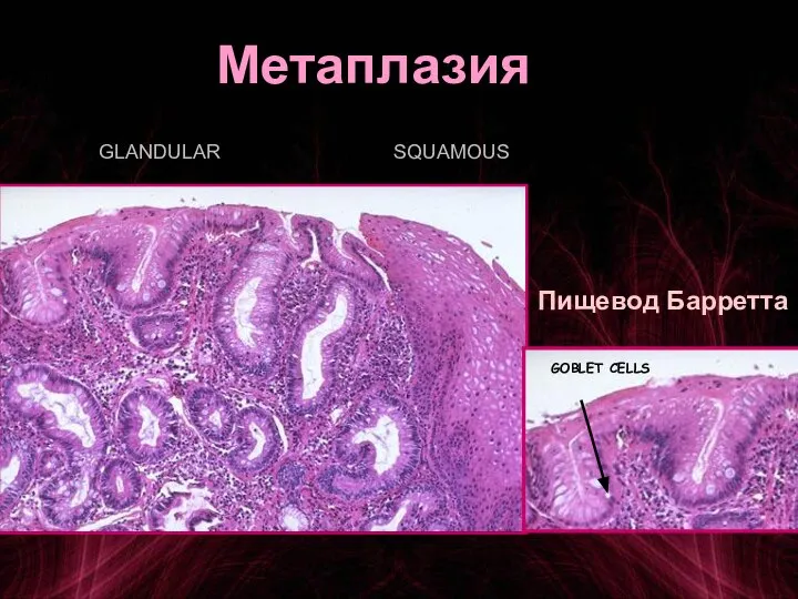 Метаплазия SQUAMOUS Пищевод Барретта GLANDULAR GOBLET CELLS