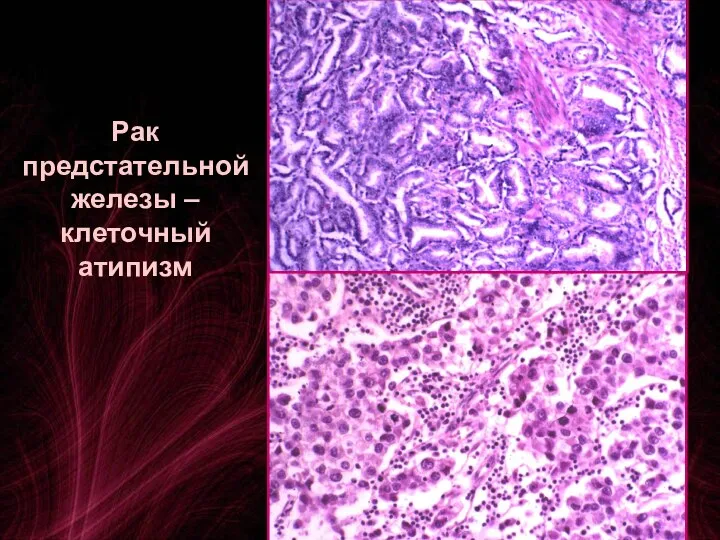 Рак предстательной железы – клеточный атипизм