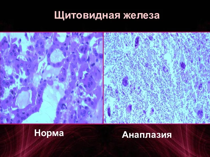 Щитовидная железа Анаплазия Норма