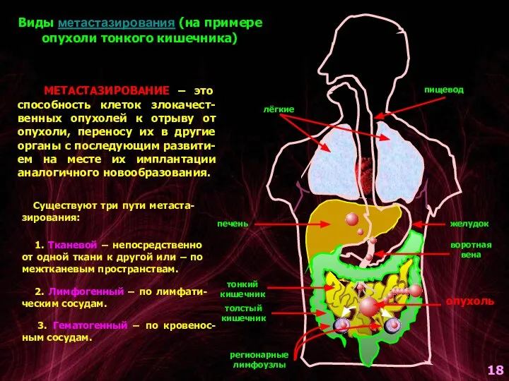 Виды метастазирования (на примере опухоли тонкого кишечника) пищевод желудок печень тонкий кишечник