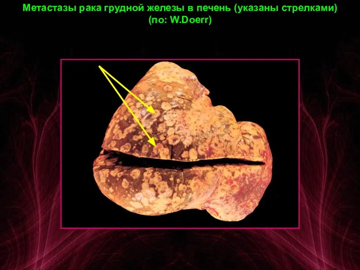 Метастазы рака грудной железы в печень (указаны стрелками) (по: W.Doerr)