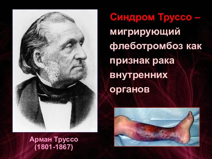 Арман Труссо (1801-1867) Синдром Труссо – мигрирующий флеботромбоз как признак рака внутренних органов