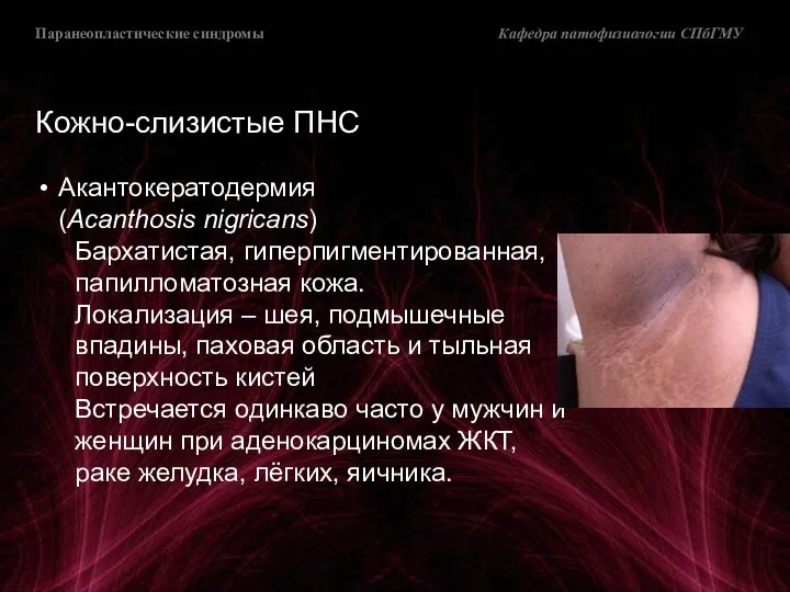 Паранеопластические синдромы Кафедра патофизиологии СПбГМУ Кожно-слизистые ПНС Акантокератодермия (Acanthosis nigricans) Бархатистая, гиперпигментированная,