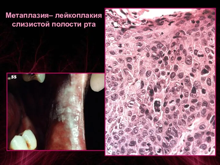 Метаплазия– лейкоплакия слизистой полости рта