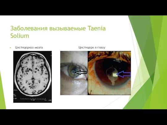 Заболевания вызываемые Taenia Solium Цистицеркоз мозга Цистицерк в глазу