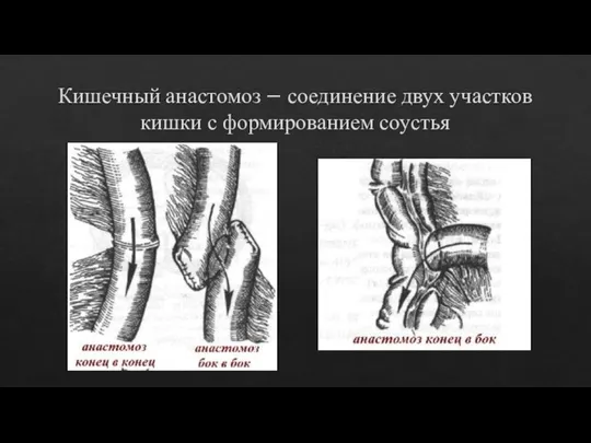 Кишечный анастомоз – соединение двух участков кишки с формированием соустья