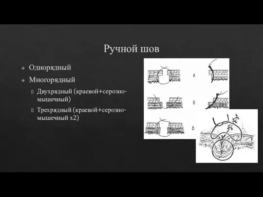 Ручной шов Однорядный Многорядный Двухрядный (краевой+серозно-мышечный) Трехрядный (краевой+серозно-мышечный х2)