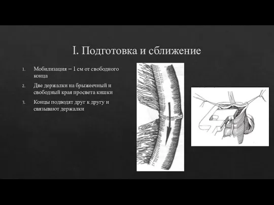 I. Подготовка и сближение Мобилизация – 1 см от свободного конца Две