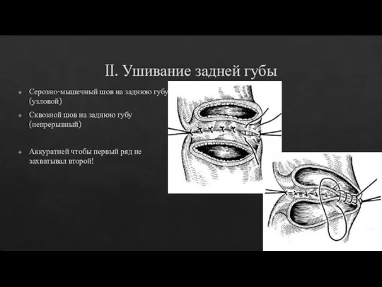 II. Ушивание задней губы Серозно-мышечный шов на заднюю губу (узловой) Сквозной шов