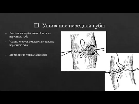 III. Ушивание передней губы Вворачивающий сквозной шов на переднюю губу Узловые серозно-мышечные