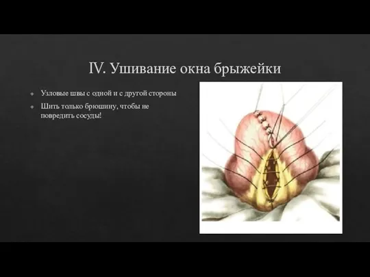 IV. Ушивание окна брыжейки Узловые швы с одной и с другой стороны