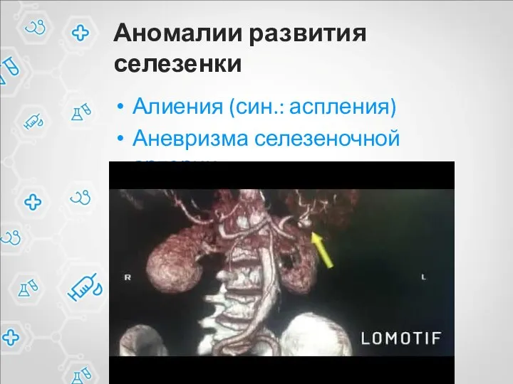 Аномалии развития селезенки Алиения (син.: аспления) Аневризма селезеночной артерии