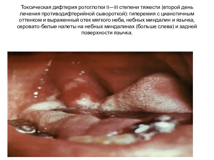 Токсическая дифтерия ротоглотки II—III степени тяжести (второй день лечения противодифтерийной сывороткой): гиперемия