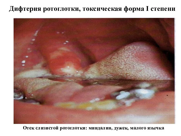 Дифтерия ротоглотки, токсическая форма I степени Отек слизистой ротоглотки: миндалин, дужек, малого язычка