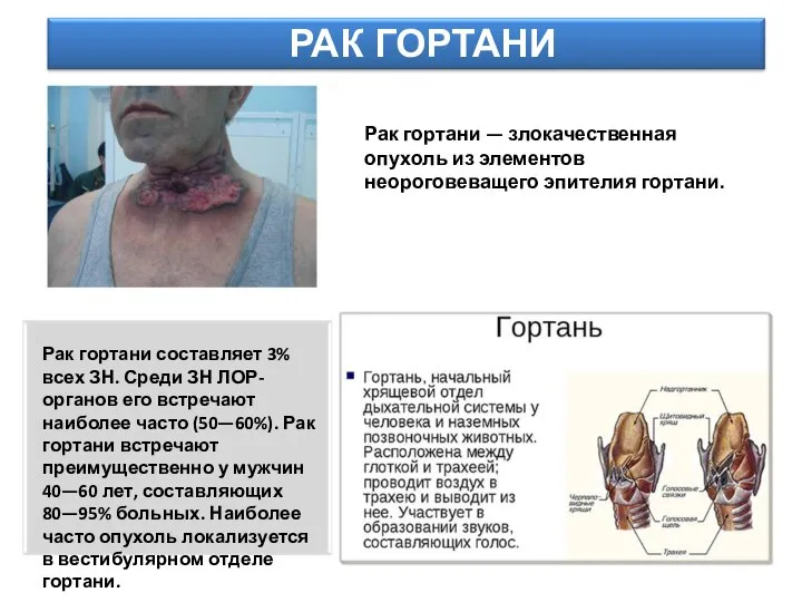 РАК ГОРТАНИ Рак гортани — злокачественная опухоль из элементов неороговеващего эпителия гортани.