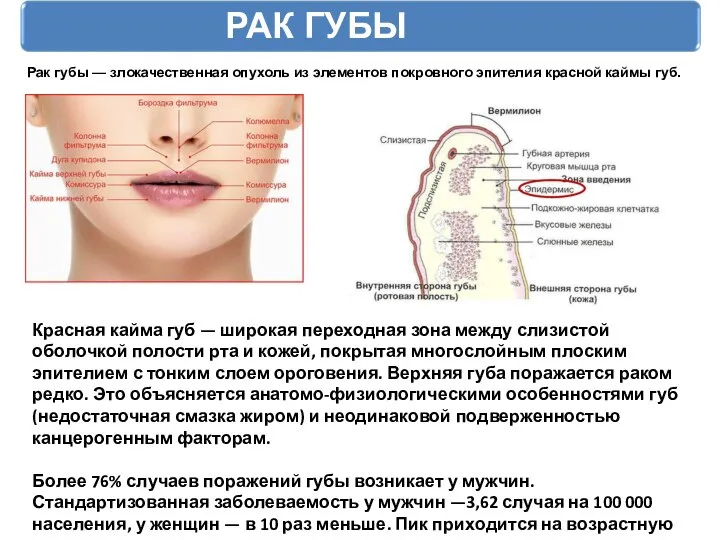 РАК ГУБЫ Рак губы — злокачественная опухоль из элементов покровного эпителия красной