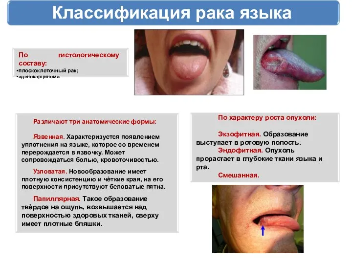 Классификация рака языка По гистологическому составу: плоскоклеточный рак; аденокарцинома. Различают три анатомические