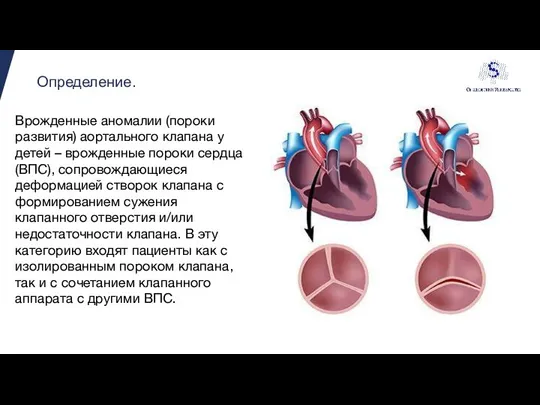 Определение. Врожденные аномалии (пороки развития) аортального клапана у детей – врожденные пороки