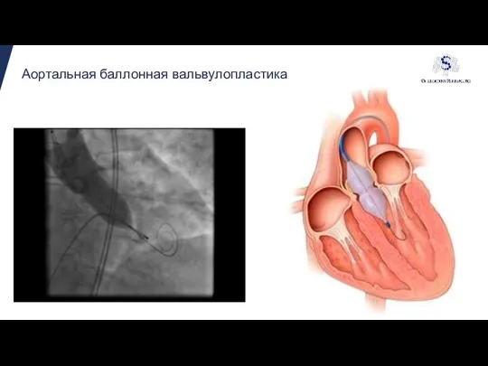 Аортальная баллонная вальвулопластика