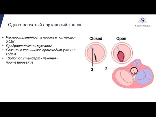 Одностворчатый аортальный клапан Распространенность порока в популяции - 0,02% Предрасположены мужчины Развитие