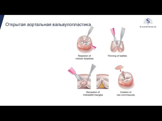 Открытая аортальная вальвулопластика