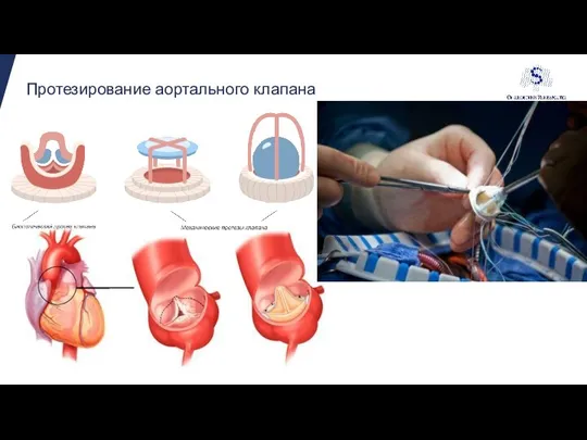 Протезирование аортального клапана