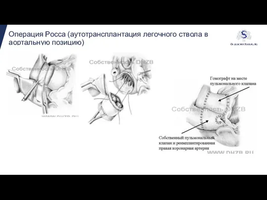 Операция Росса (аутотрансплантация легочного ствола в аортальную позицию)