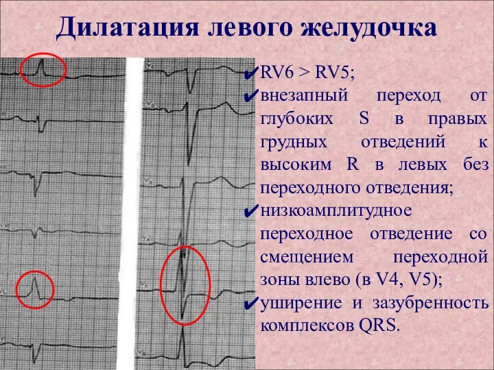 Дилатация левого желудочка RV6 > RV5; внезапный переход от глубоких S в