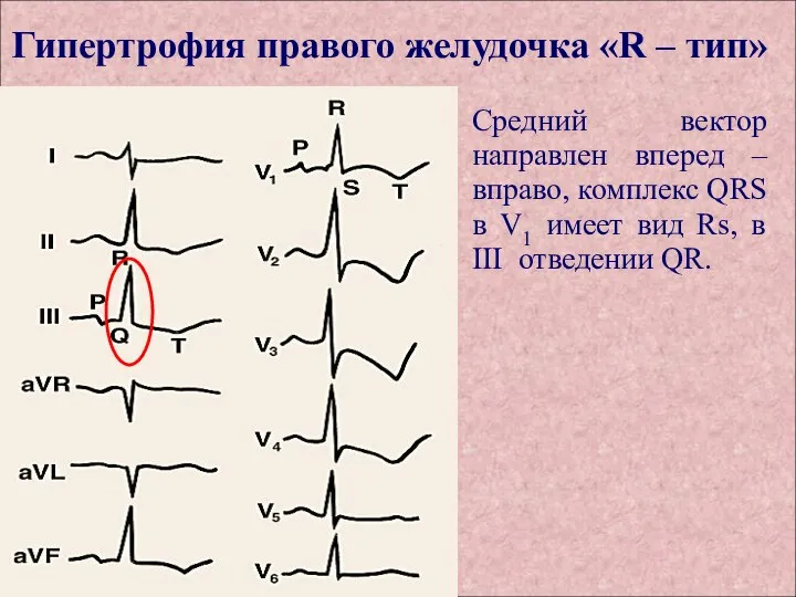 Гипертрофия правого желудочка «R – тип» Средний вектор направлен вперед – вправо,