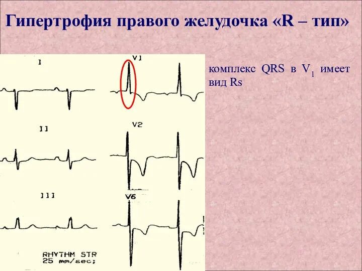 Гипертрофия правого желудочка «R – тип» комплекс QRS в V1 имеет вид Rs