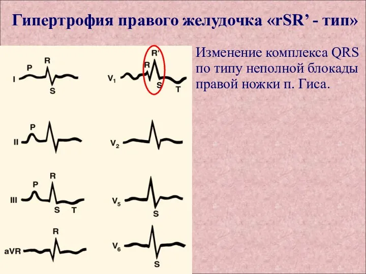 Гипертрофия правого желудочка «rSR’ - тип» Изменение комплекса QRS по типу неполной