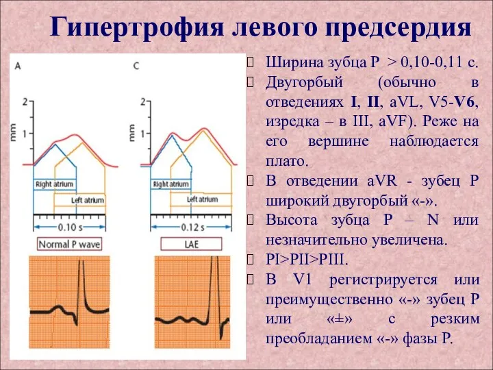 Гипертрофия левого предсердия Ширина зубца P > 0,10-0,11 с. Двугорбый (обычно в