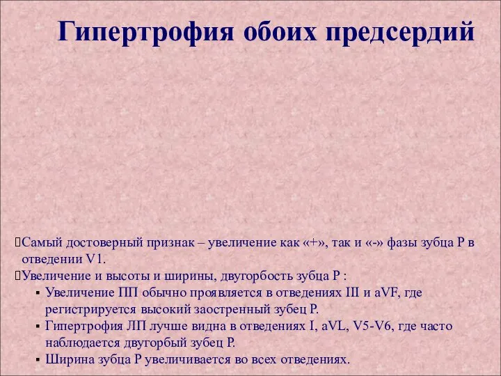 Гипертрофия обоих предсердий Самый достоверный признак – увеличение как «+», так и