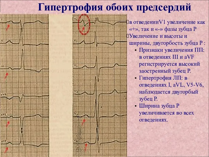 в отведенииV1 увеличение как «+», так и «-» фазы зубца P Увеличение