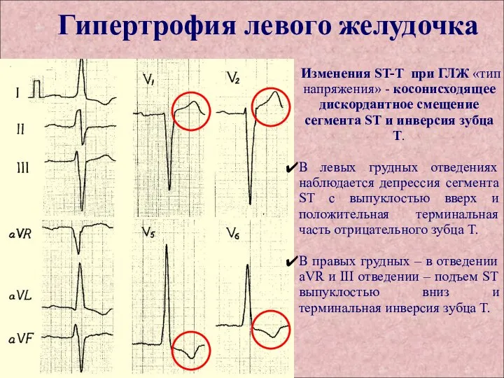 Гипертрофия левого желудочка Изменения ST-T при ГЛЖ «тип напряжения» - косонисходящее дискордантное
