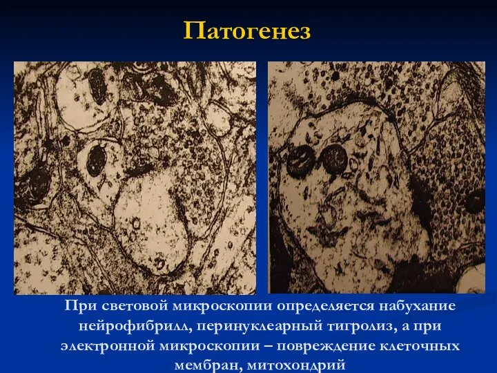 При световой микроскопии определяется набухание нейрофибрилл, перинуклеарный тигролиз, а при электронной микроскопии