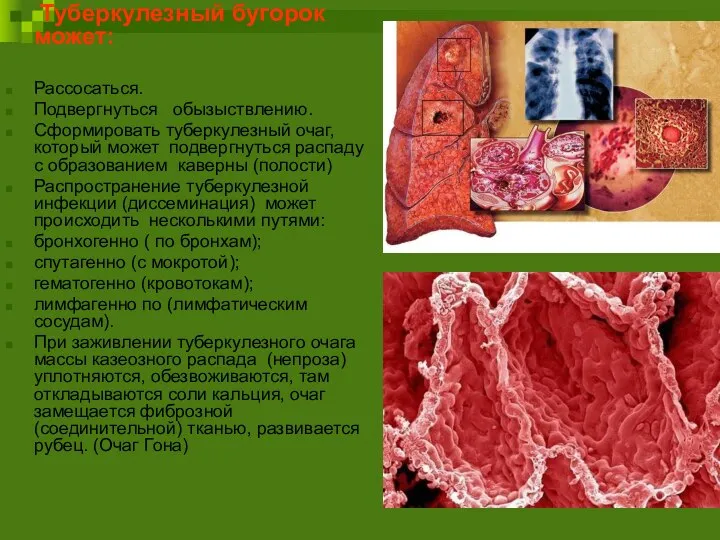 Туберкулезный бугорок может: Рассосаться. Подвергнуться обызыствлению. Сформировать туберкулезный очаг, который может подвергнуться