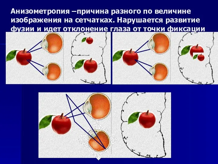 Анизометропия –причина разного по величине изображения на сетчатках. Нарушается развитие фузии и