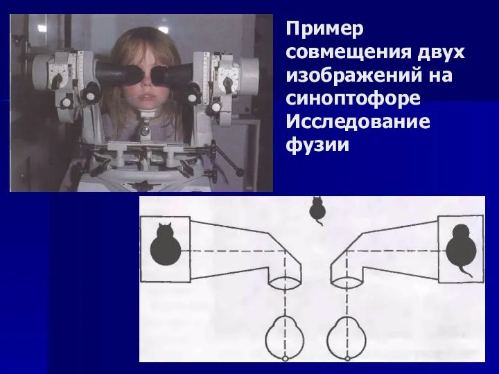 Пример совмещения двух изображений на синоптофоре Исследование фузии