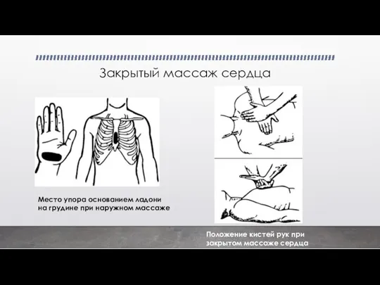 Закрытый массаж сердца Место упора основанием ладони на грудине при наружном массаже