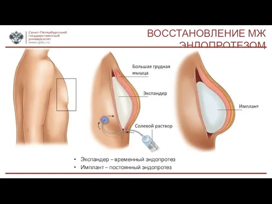 ВОССТАНОВЛЕНИЕ МЖ ЭНДОПРОТЕЗОМ Экспандер – временный эндопротез Имплант – постоянный эндопротез