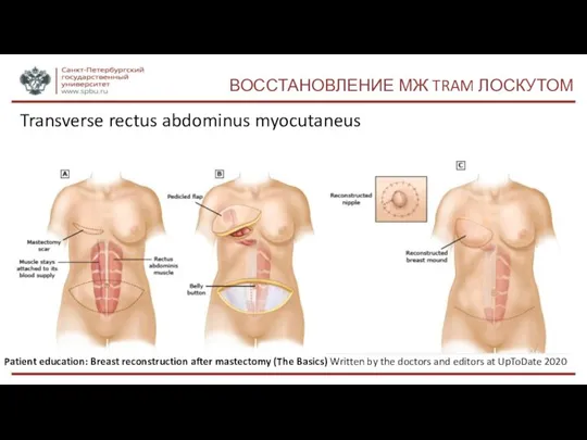 ВОССТАНОВЛЕНИЕ МЖ TRAM ЛОСКУТОМ Transverse rectus abdominus myocutaneus Patient education: Breast reconstruction