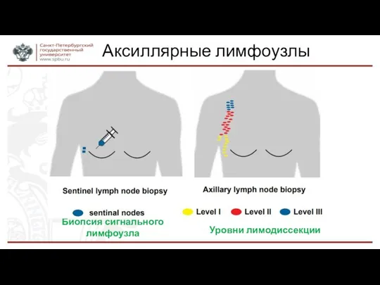 Аксиллярные лимфоузлы Биопсия сигнального лимфоузла Уровни лимодиссекции