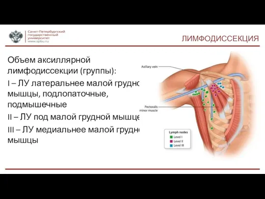 ЛИМФОДИССЕКЦИЯ Объем аксиллярной лимфодиссекции (группы): I – ЛУ латеральнее малой грудной мышцы,