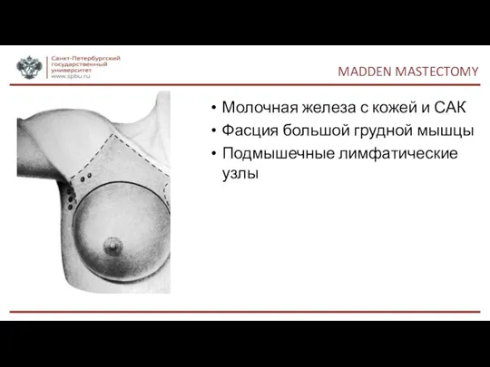 MADDEN MASTECTOMY Молочная железа с кожей и САК Фасция большой грудной мышцы Подмышечные лимфатические узлы