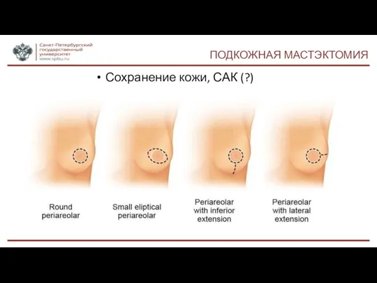 ПОДКОЖНАЯ МАСТЭКТОМИЯ Сохранение кожи, САК (?)