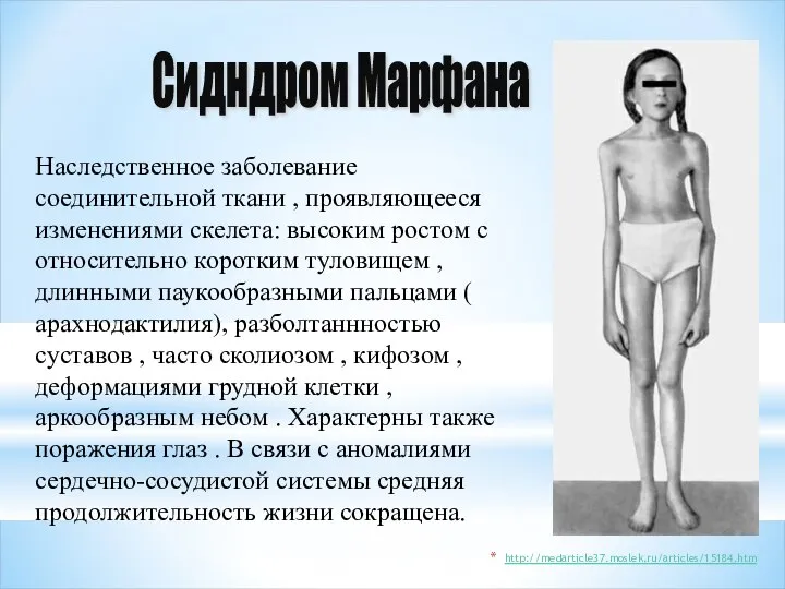 http://medarticle37.moslek.ru/articles/15184.htm Сидндром Марфана Наследственное заболевание соединительной ткани , проявляющееся изменениями скелета: высоким