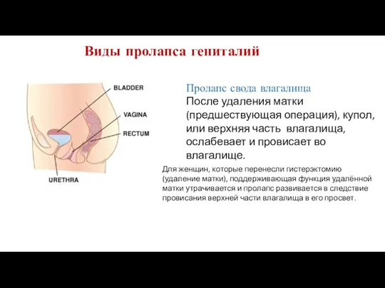 Пролапс свода влагалища После удаления матки (предшествующая операция), купол, или верхняя часть